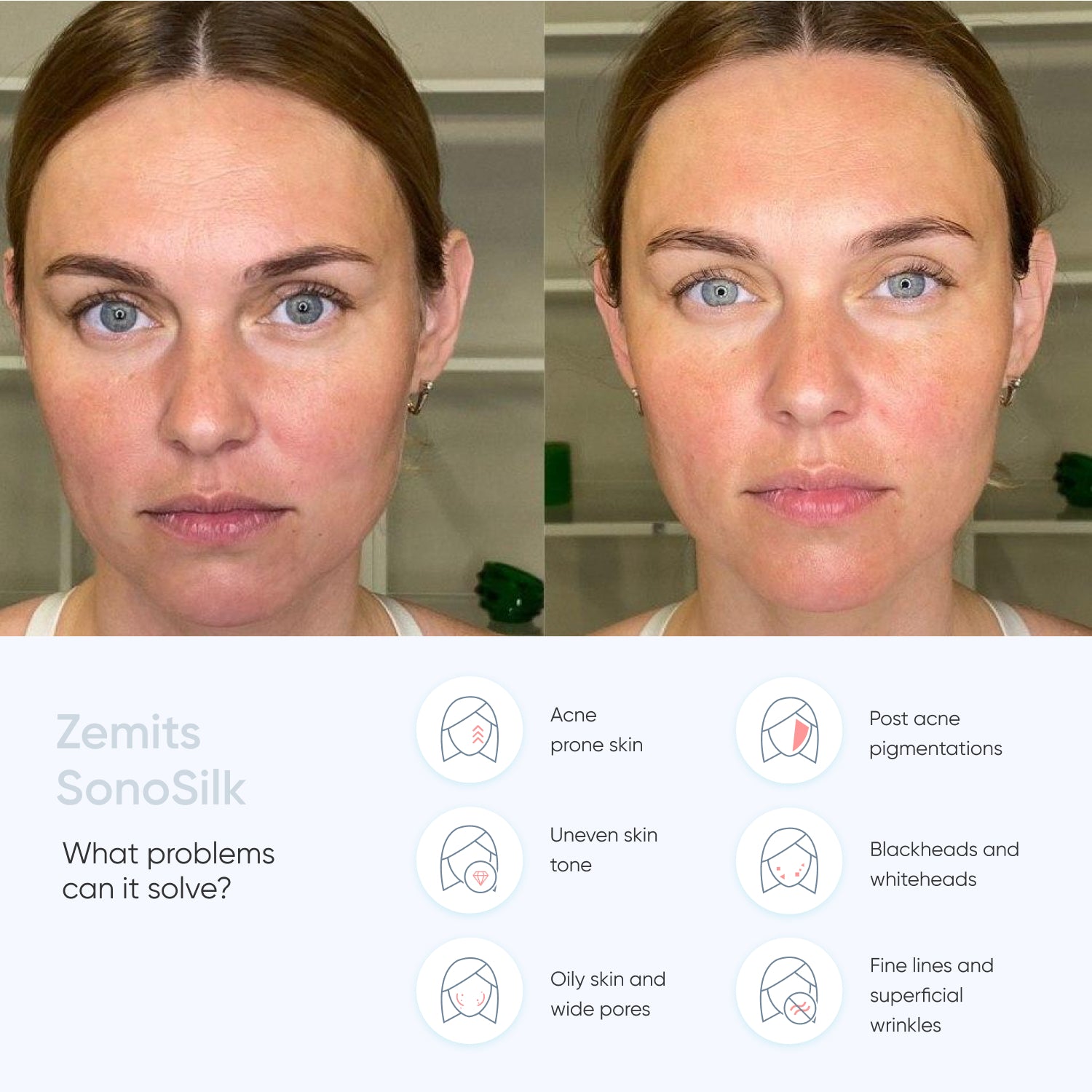 Zemits SonoSilk Ultrasonic Skin Scrubber