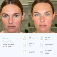 Zemits SonoSilk Ultrasonic Skin Scrubber